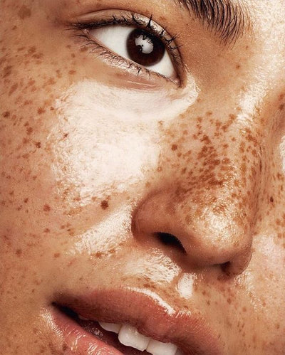 L'hyperpigmentation